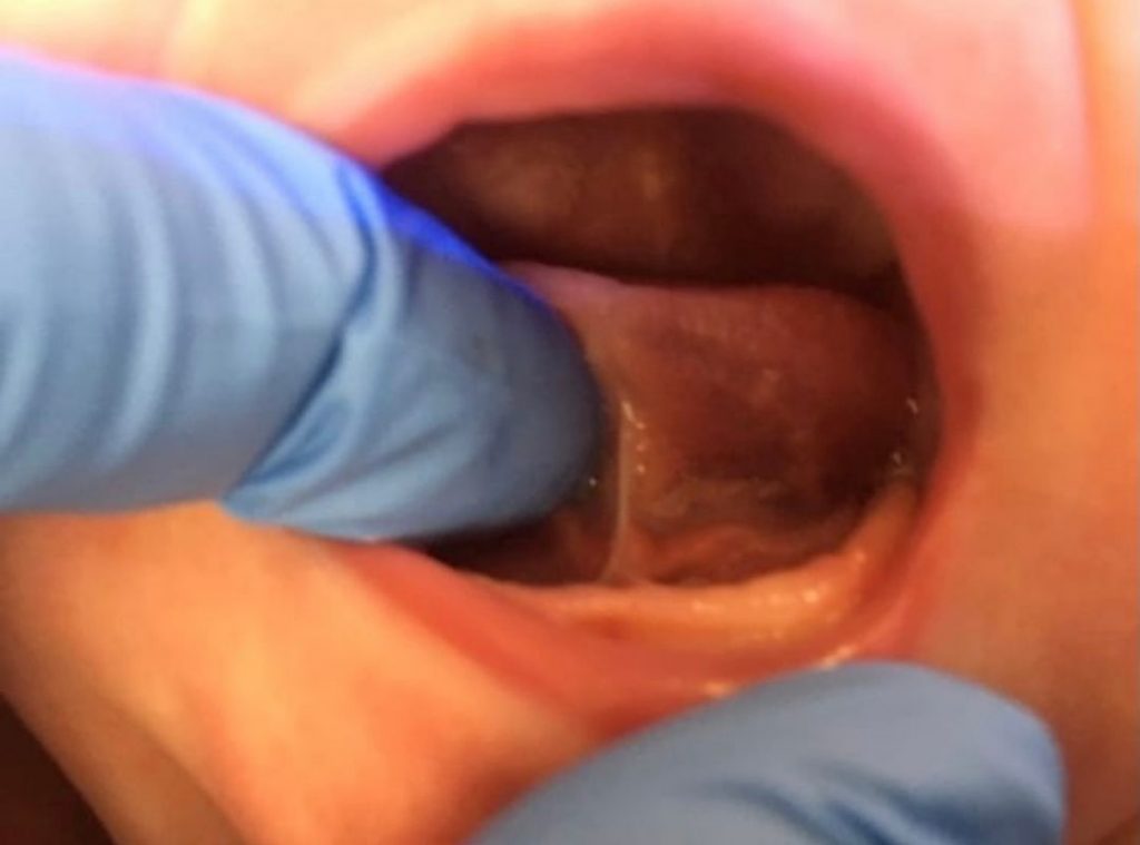 Baby born with Tongue-tied